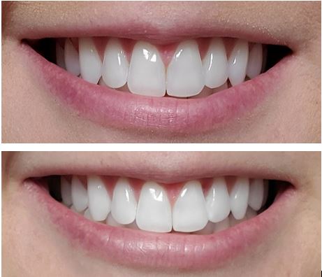 Before and after teeth whitening photos
